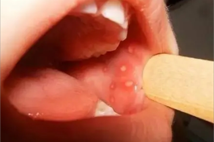 溃疡性口炎口腔白斑图 溃疡性口炎口腔白斑图