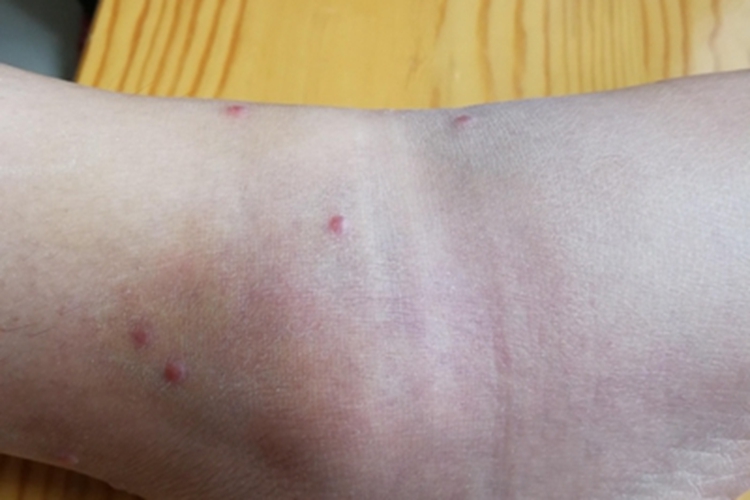 蚊虫叮咬脚踝小红疙瘩图 蚊虫叮咬脚踝小红疙瘩图