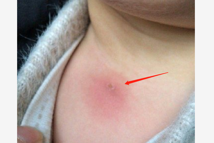 小儿胸前瘘管图