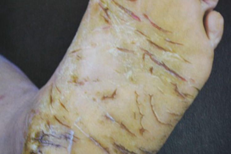 更年期角皮症裂口图