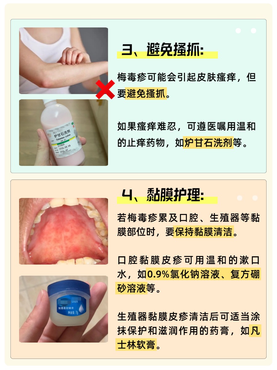 一夜之间，梅毒疹悄然现身是真的吗？