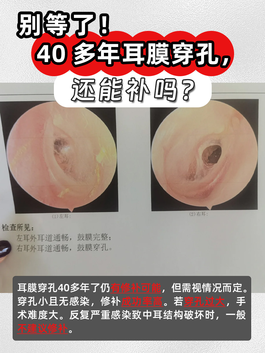 别等了!40多年耳膜穿孔,还能补吗?