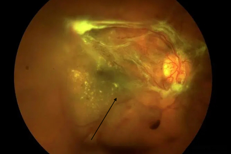 牵拉性视网膜脱离图