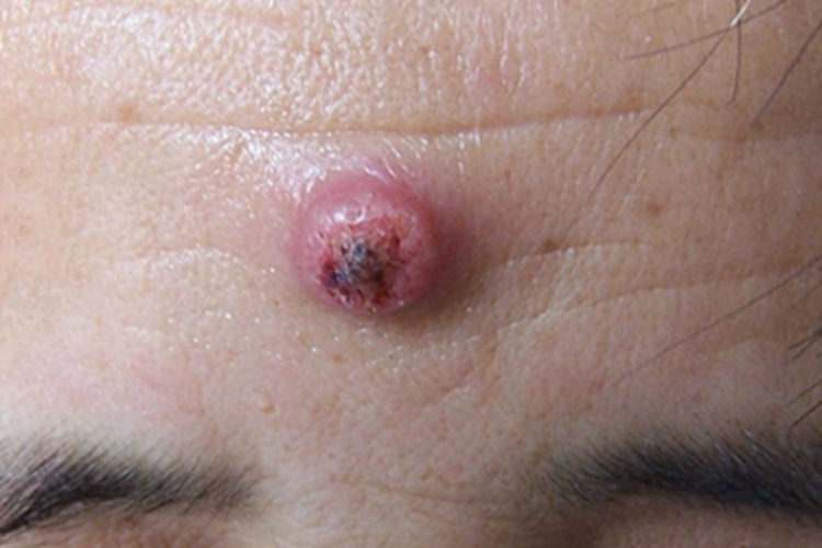 毛鞘棘皮瘤结节图