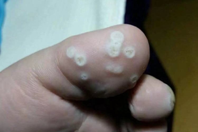 疣脚趾圆疙瘩图