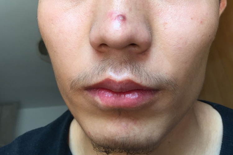 毛囊炎图 毛囊炎图