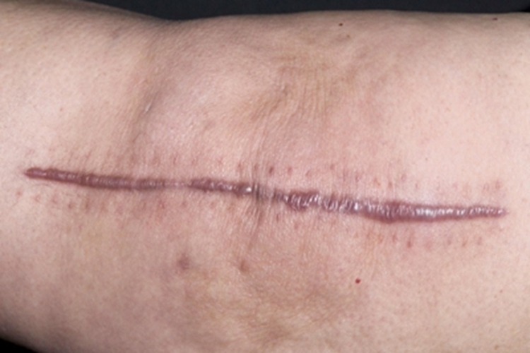 瘢痕疙瘩症状图