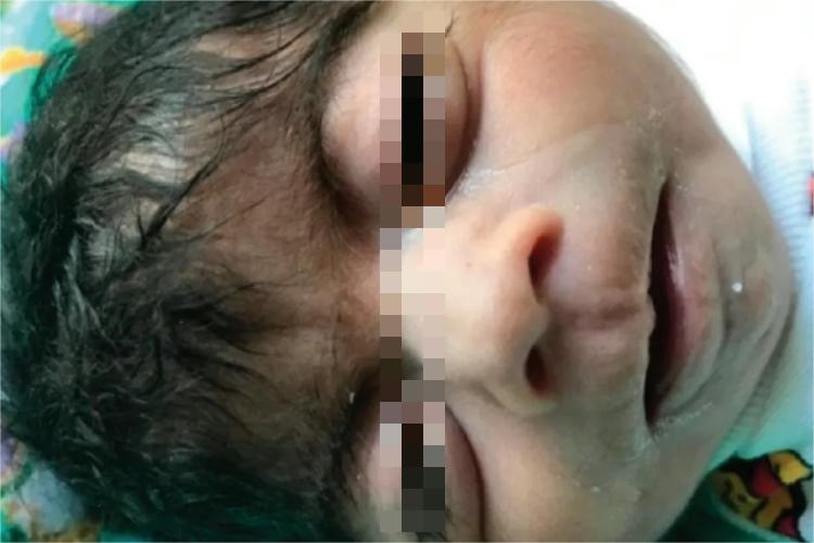 德朗热综合征多毛图