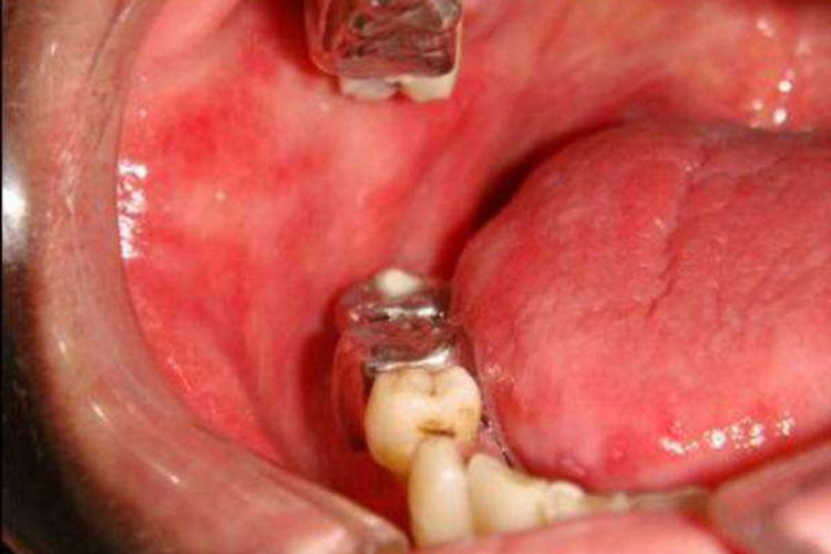 慢性红斑型(萎缩型)念珠菌病图