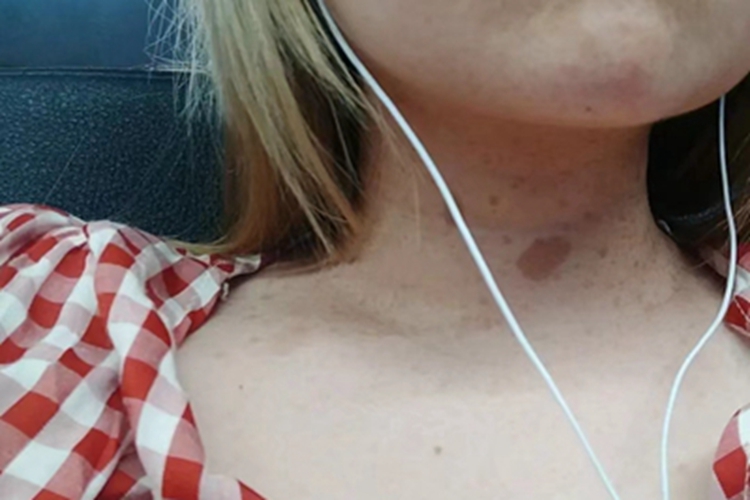 咖啡斑脖子前面有浅棕色斑图 咖啡斑脖子前面有浅棕色斑图