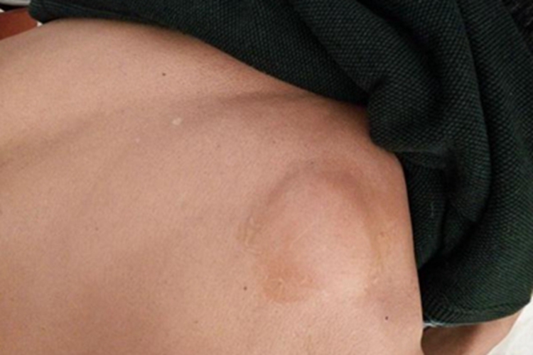 血管脂肪瘤小疙瘩图 血管脂肪瘤小疙瘩图