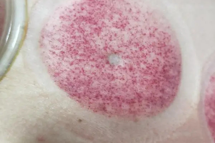 拔罐后正常血点图