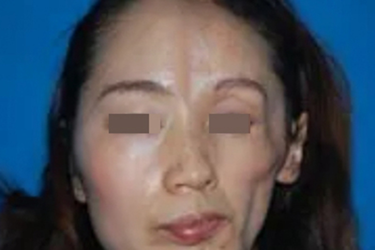 进行性单侧面萎缩肌肉萎缩图 进行性单侧面萎缩肌肉萎缩图