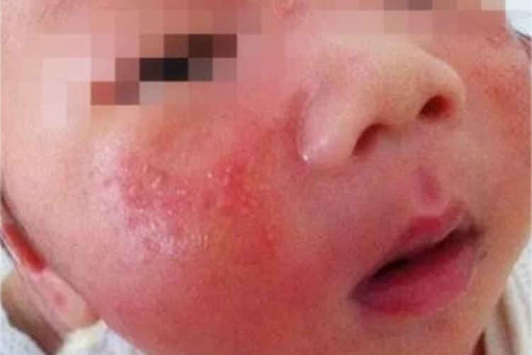 特应性皮炎疙瘩图 特应性皮炎疙瘩图