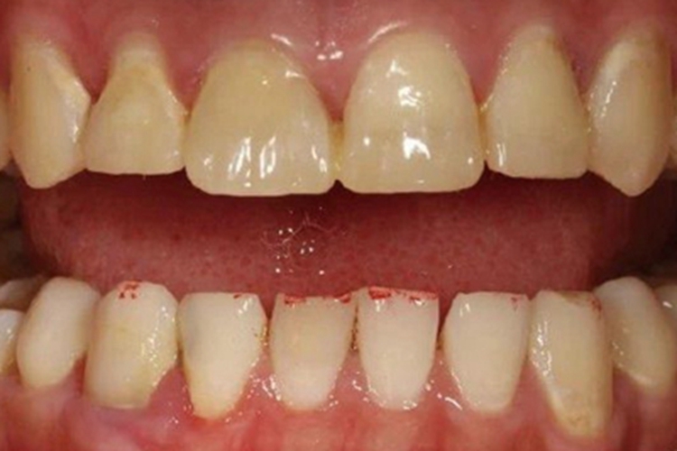 酸蚀症牙齿缺损不平整图