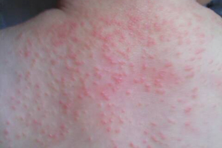 痱子背部症状图 痱子背部症状图