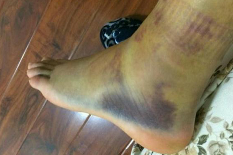 腓骨远端撕脱性骨折脚踝肿胀图 腓骨远端撕脱性骨折脚踝肿胀图