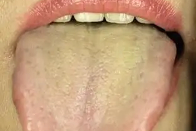 肝胆湿热舌苔表现图 肝胆湿热舌苔表现图