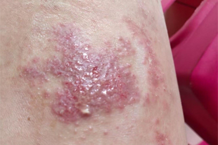 急性湿疹腿丘疹图 急性湿疹腿丘疹图