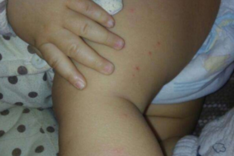 小儿丘疹性肢端皮炎大腿有红点图
