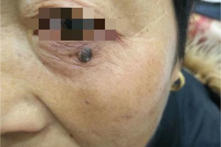 脂溢性角化病眼周丘疹图