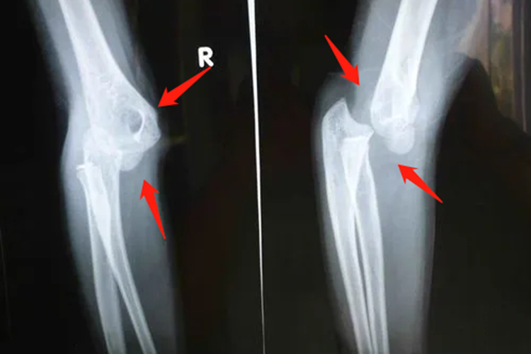 婴儿肘关节脱臼图