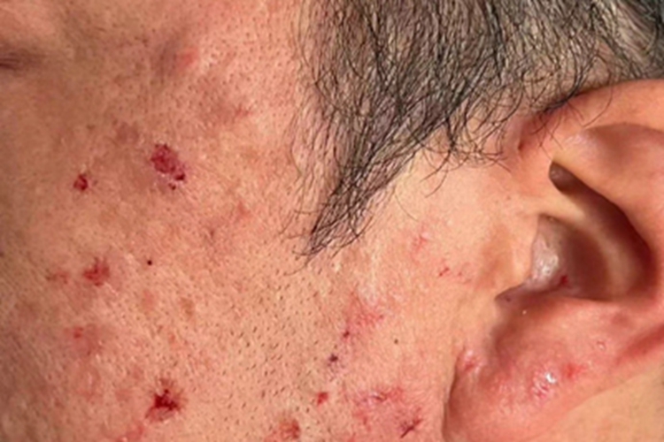 结节性类天疱疮面部硬疙瘩图