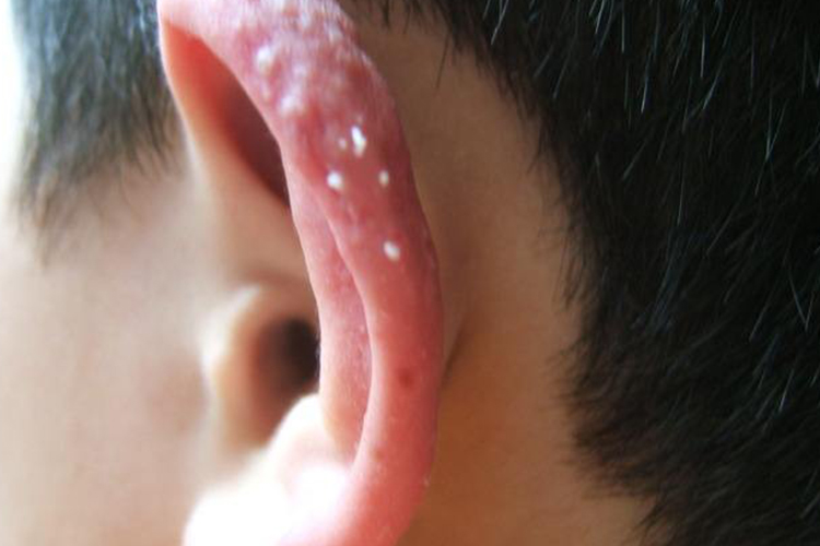 耳朵长脂肪粒图 耳朵长脂肪粒图