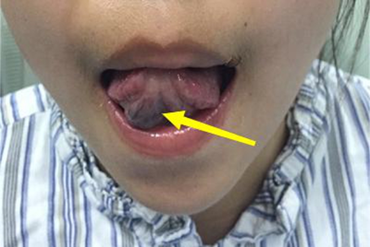 血管瘤舌头包块图