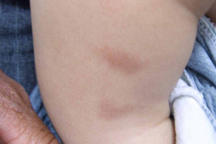 色素性荨麻疹症状图