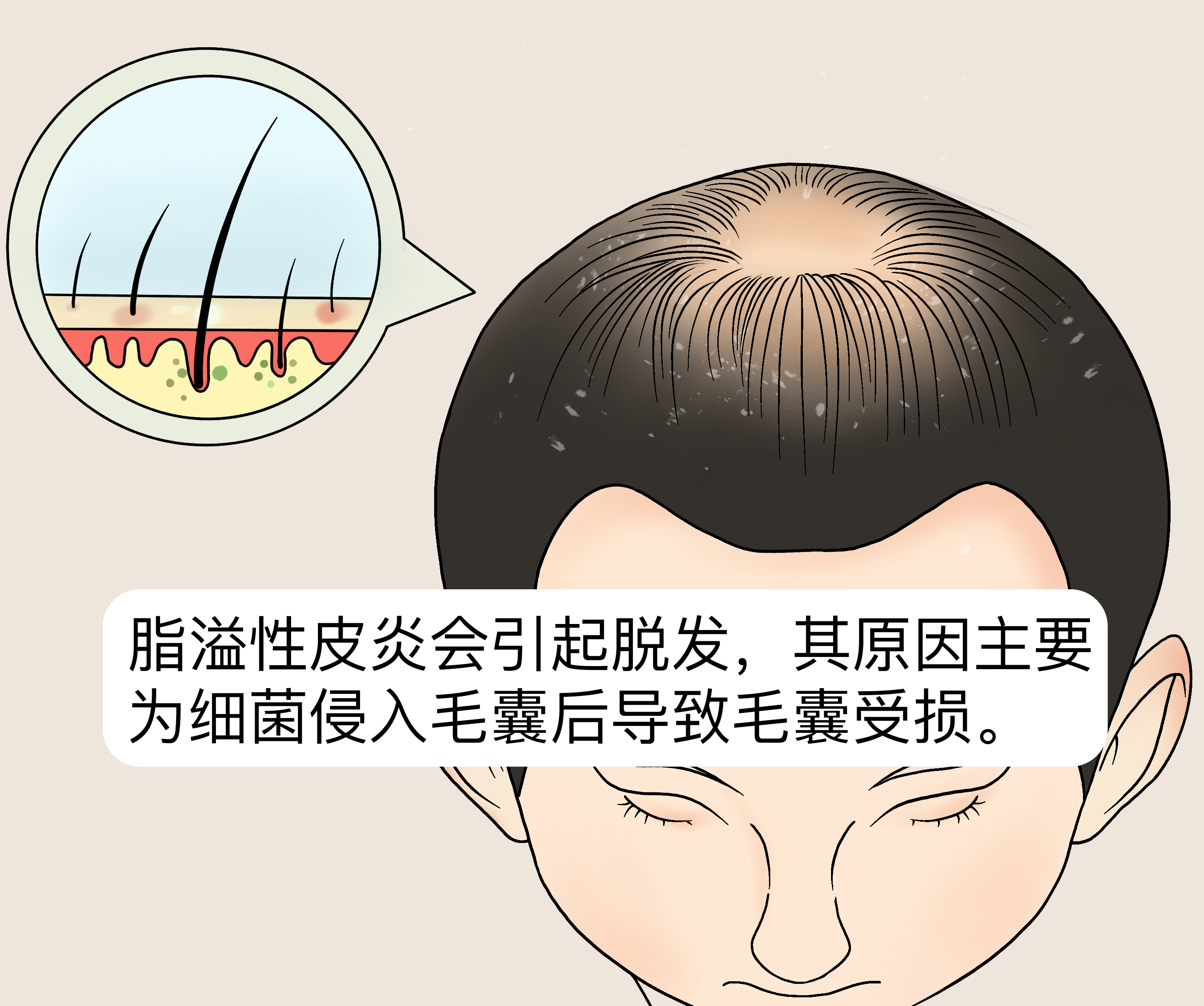 你的脂溢性皮炎是怎么好的？_洗发护发_什么值得买