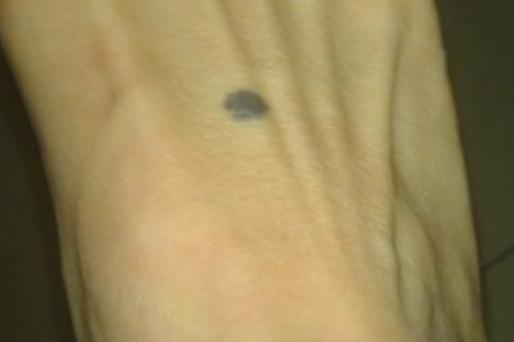 浅表扩散性黑素瘤脚背症状图 浅表扩散性黑素瘤脚背症状图