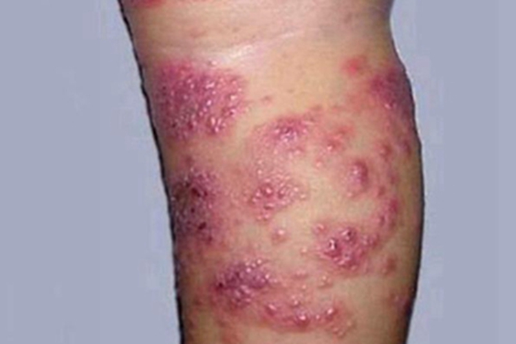 急性湿疹小腿大量小红疙瘩图