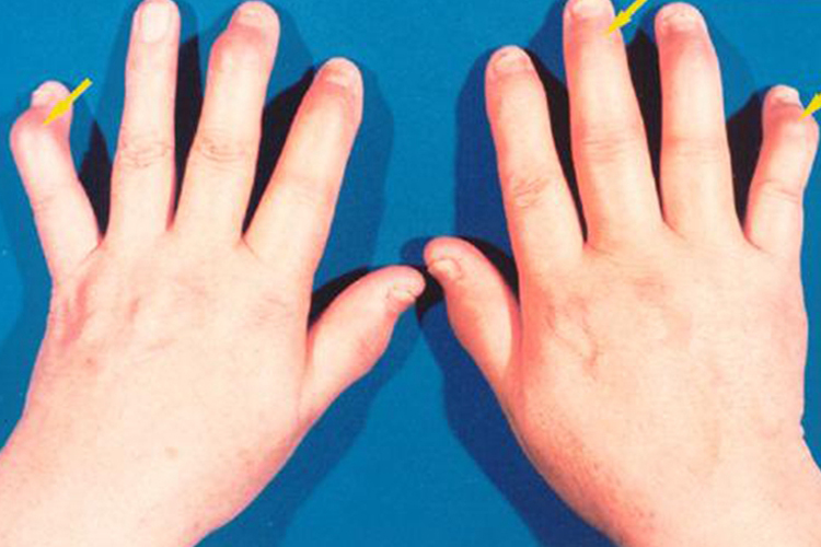 类风湿关节炎图