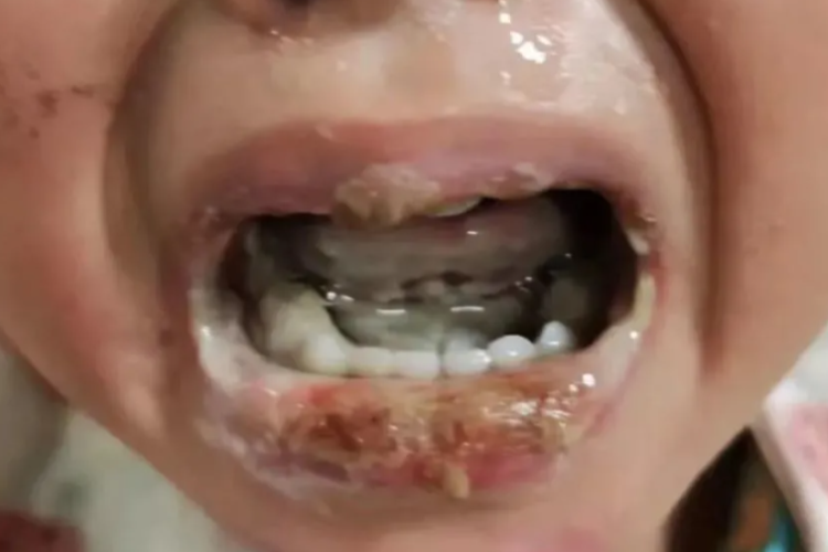 宝宝口腔烫伤糜烂图