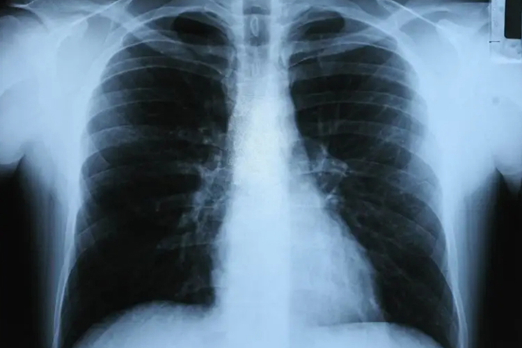 正常肺X线图