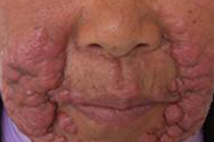 麻风病面部疙瘩图