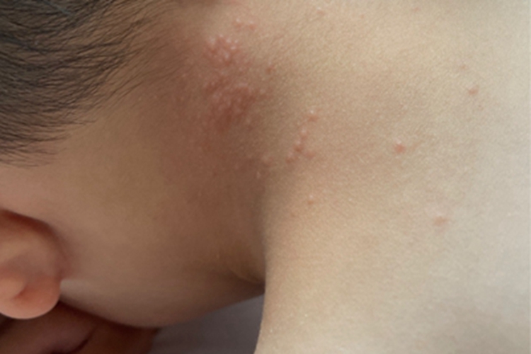 接触性荨麻疹颈部小疙瘩图