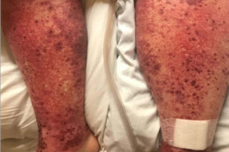 持久性隆起性红斑小腿红斑图 持久性隆起性红斑小腿红斑图