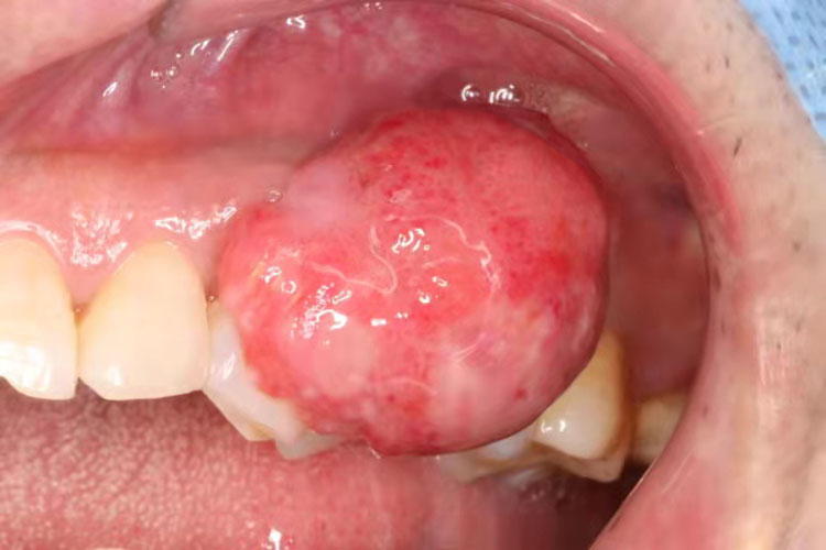 血管性牙龈瘤图