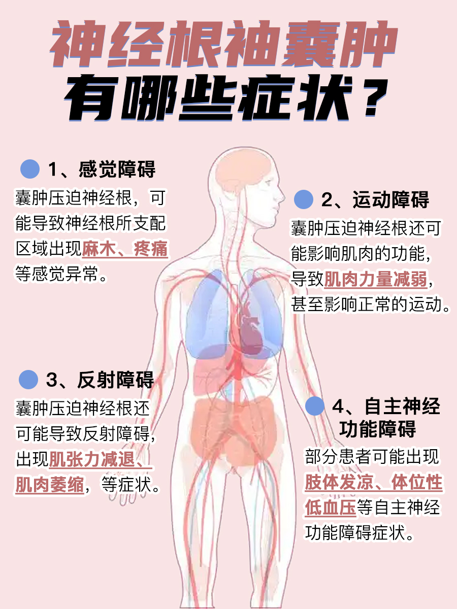 神经根袖囊肿是什么?一文带你全面了解