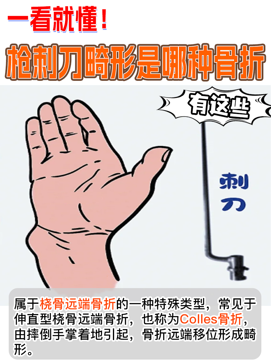 一看就懂!枪刺刀畸形是哪种骨折