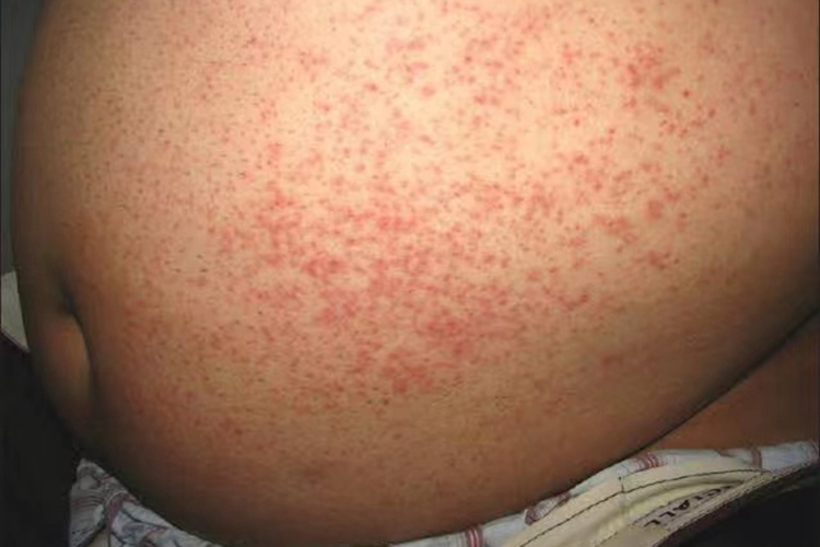 短暂性棘层松解性皮病左腹症状图