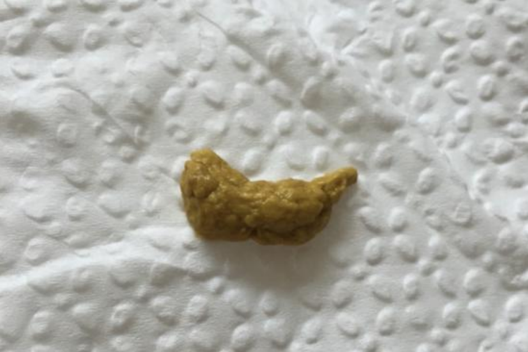 健康正常婴幼儿粪便图