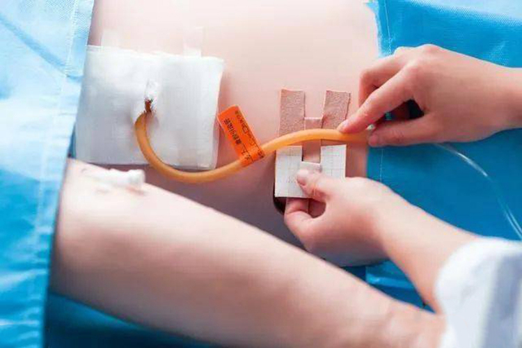 胆囊炎引流插管图