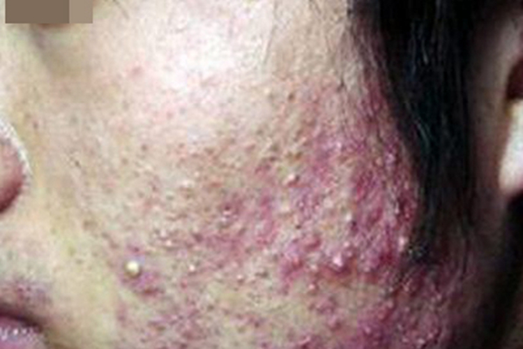 颜面粟粒性狼疮化脓图