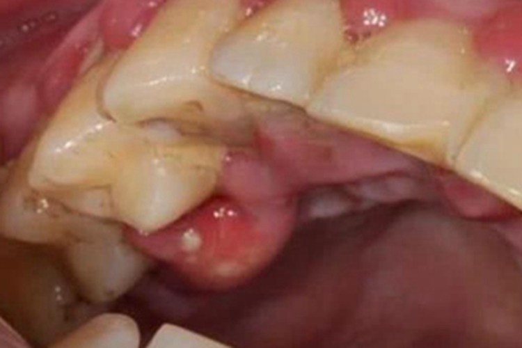 牙槽脓肿牙龈症状图