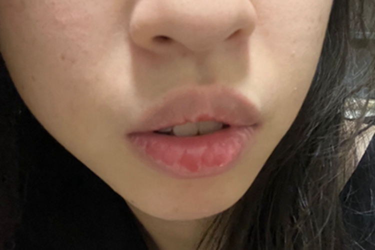 接触性唇炎嘴唇红斑图 接触性唇炎嘴唇红斑图