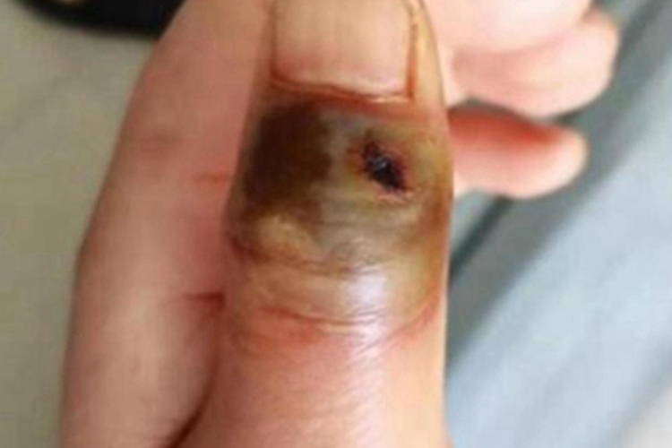 皮肤炭疽手指皮肤发黑图