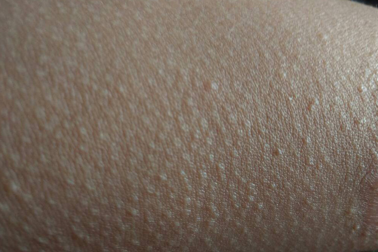 “鸡皮样”外观图